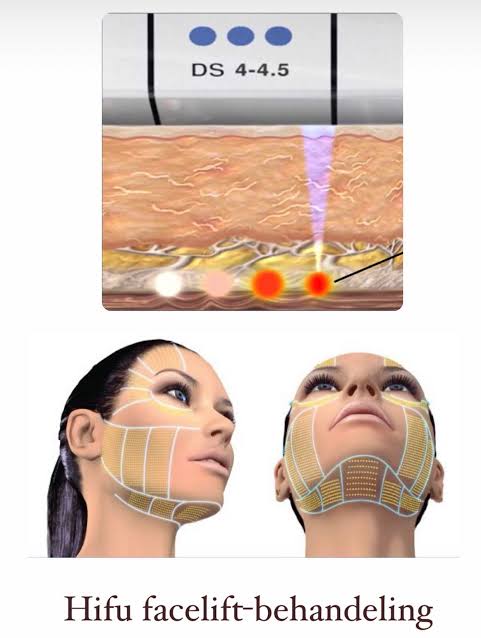 Full face (Face lift)